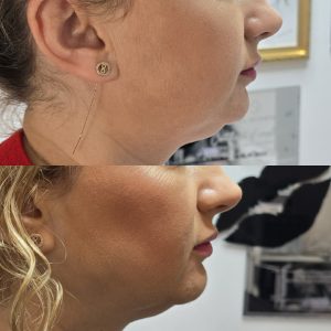 Body contouring injectable product or treatment result at Galadia Warrington