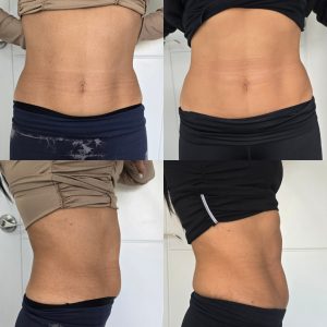Body contouring injectable product or treatment result at Galadia Warrington