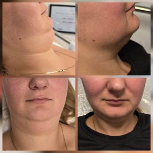 Body contouring injectable product or treatment result at Galadia Warrington