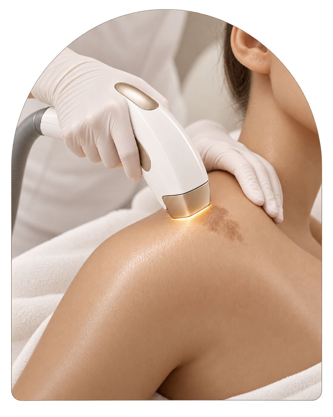Laser birthmark and pigmentation treatment at Galadia Medical Aesthetics Warrington