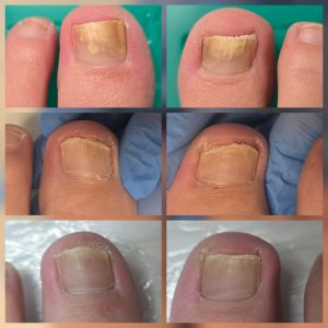 Fungal nail laser treatment Warrington