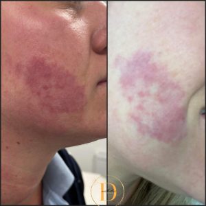 Laser pigmentation treatment Warrington