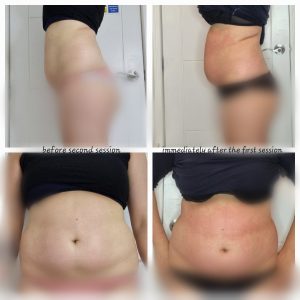 Body contouring injectable product or treatment result at Galadia Warrington