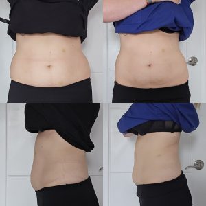 Waist hip flank body contouring Warrington