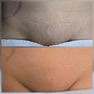 Bikini and intimate laser hair removal Warrington