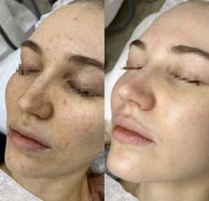 Carbon facial application Warrington