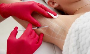 Botulinum toxin hyperhidrosis anti-sweat treatment