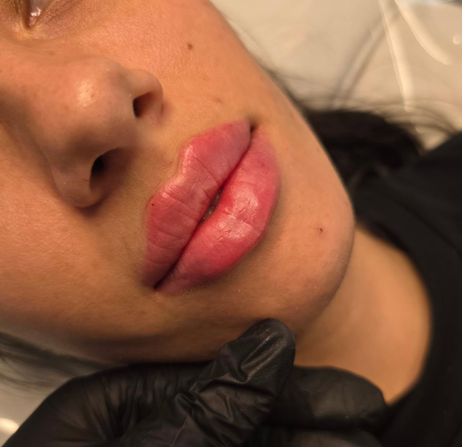 Lip dissolving treatment information in Warrington