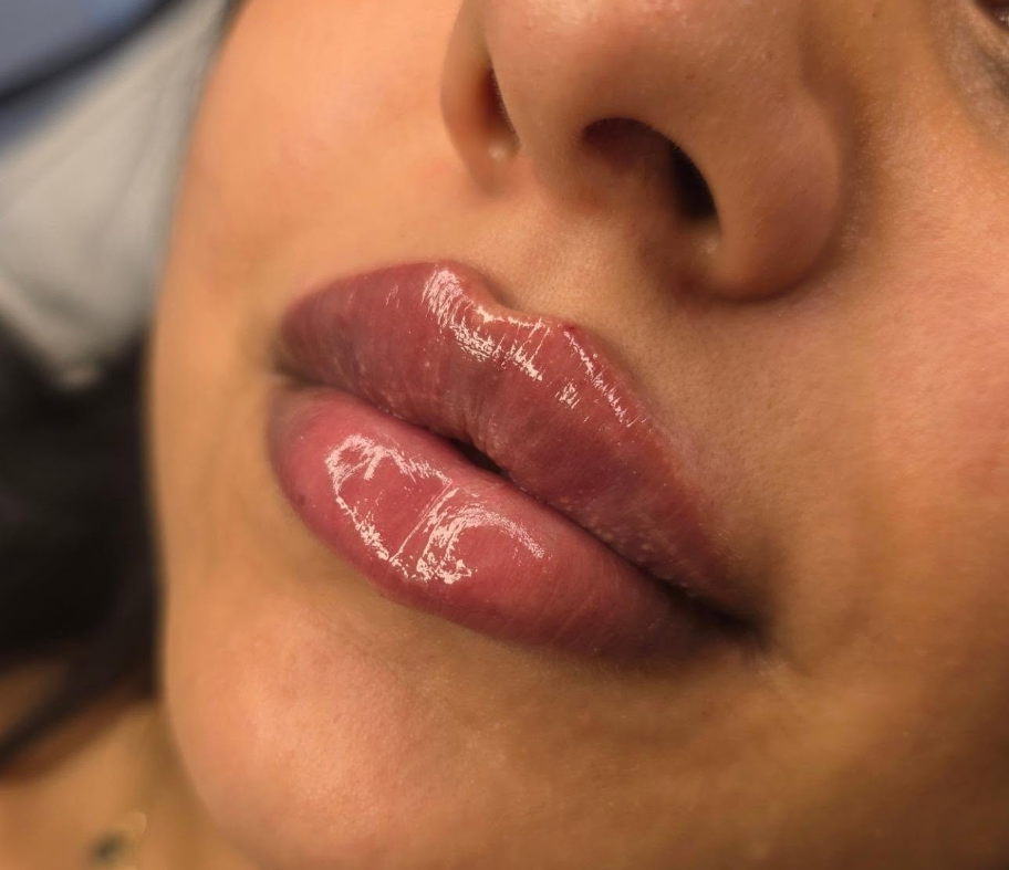 Lip correction treatment example in Warrington