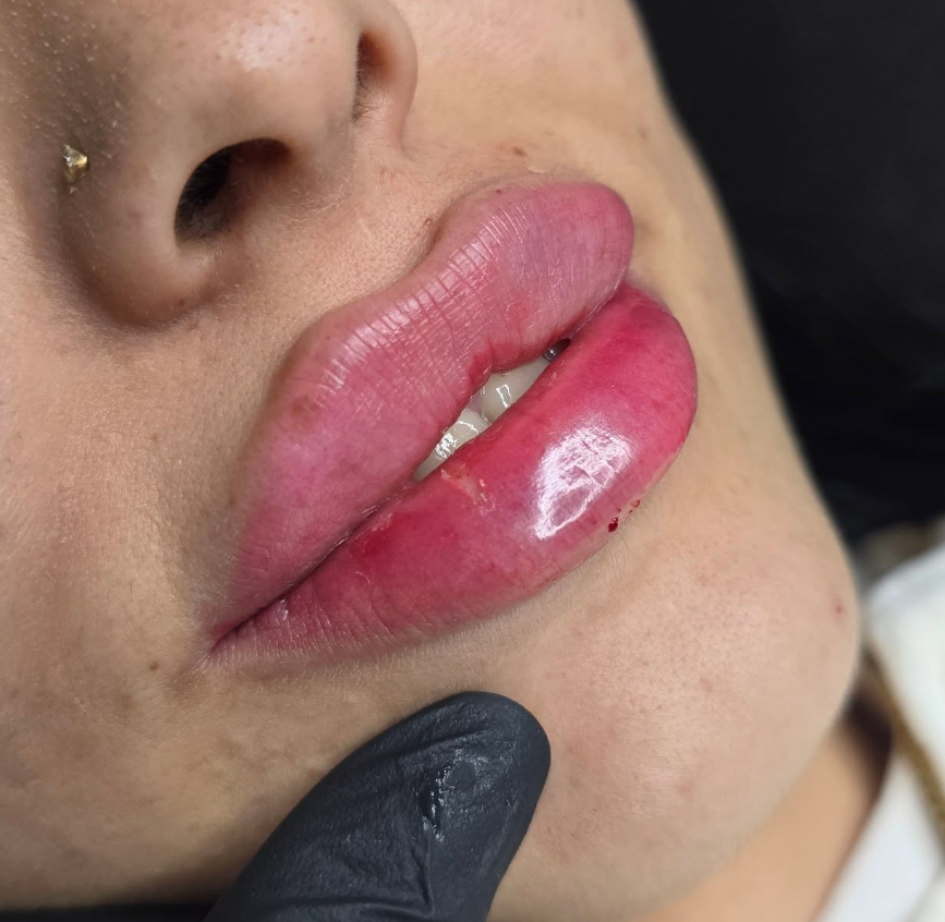 Natural lip enhancement treatment example in Warrington