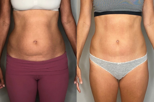 Radiofrequency skin firming Warrington