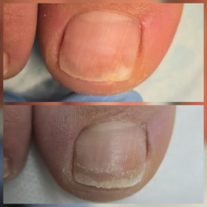 Fungal nail regrowth treatment Warrington