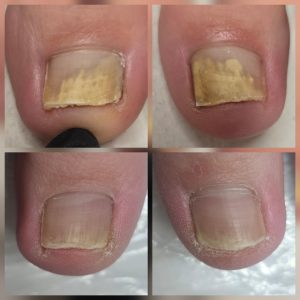 Healthier nail growth after fungal nail treatment Warrington