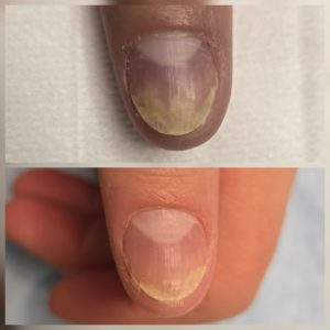 Fungal nail assessment Warrington