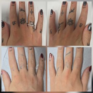 Hand tattoo laser removal Warrington