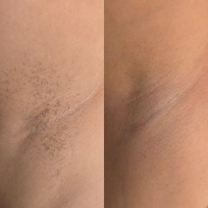 Underarm laser hair removal Warrington