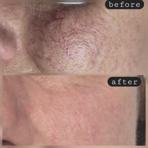 Sclerotherapy injection for spider veins Warrington