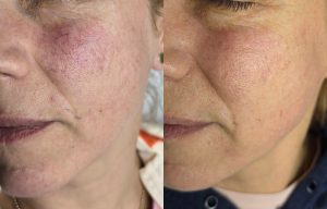 Laser vascular therapy treatment Warrington