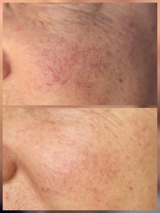 Spider and thread vein treatment Warrington