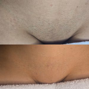 Leg and body laser hair removal for women in Warrington